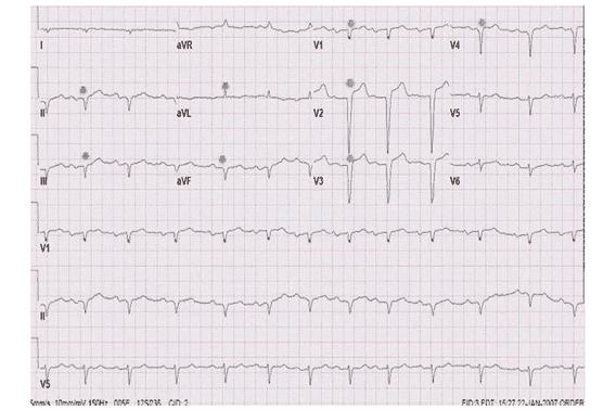ECG graph showing multiple lead readings