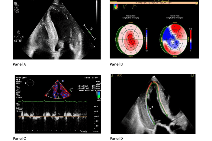 Échocardiographie montrant la structure cardiaque en niveaux de gris