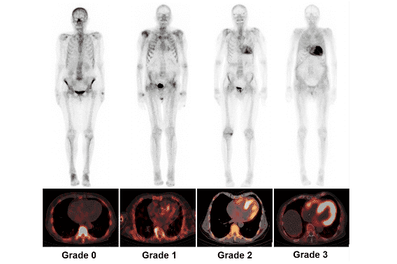 Whole‑body PET scan showing uptake patterns across different disease grades
