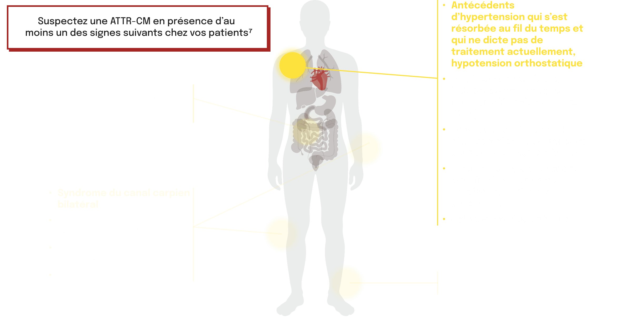 Schéma de l'atteinte cardiaque liée à l'ATTR-CM