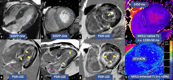 Cardiac MRI bSSFP cine showing ventricular structure