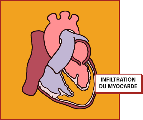 Myocarde infiltré