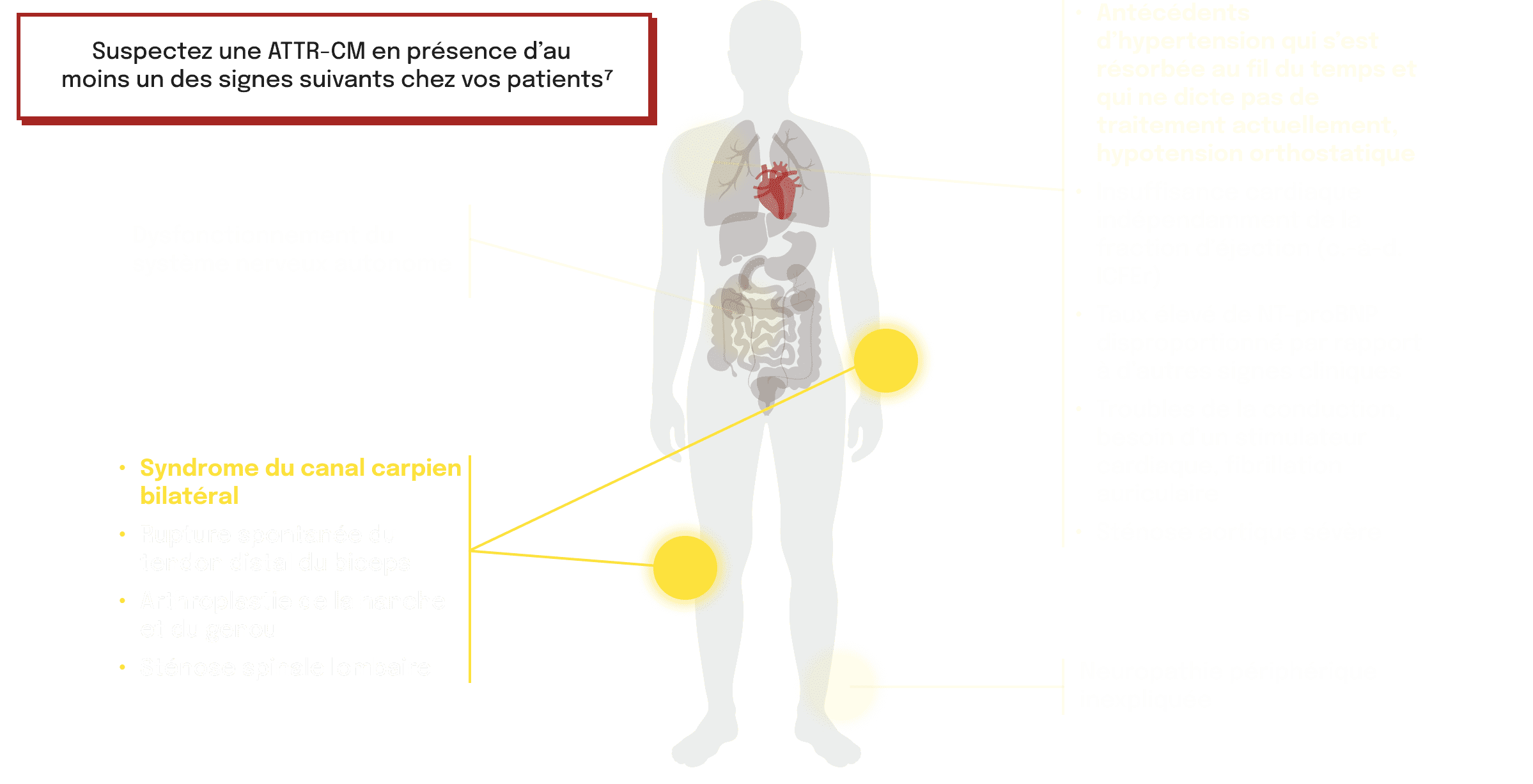 Schéma de l'atteinte cardiaque liée à l'ATTR-CM