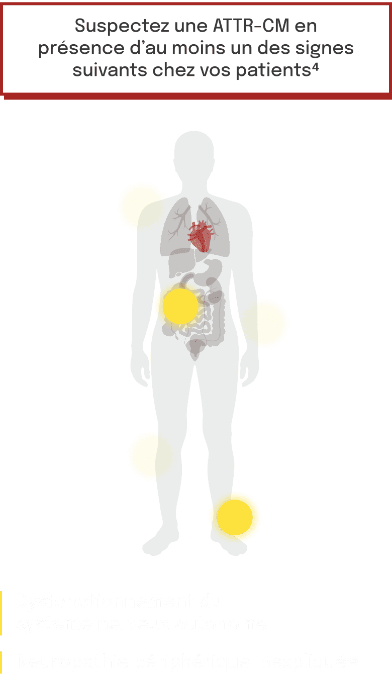 Schéma de l'atteinte cardiaque liée à l'ATTR-CM (mobile)